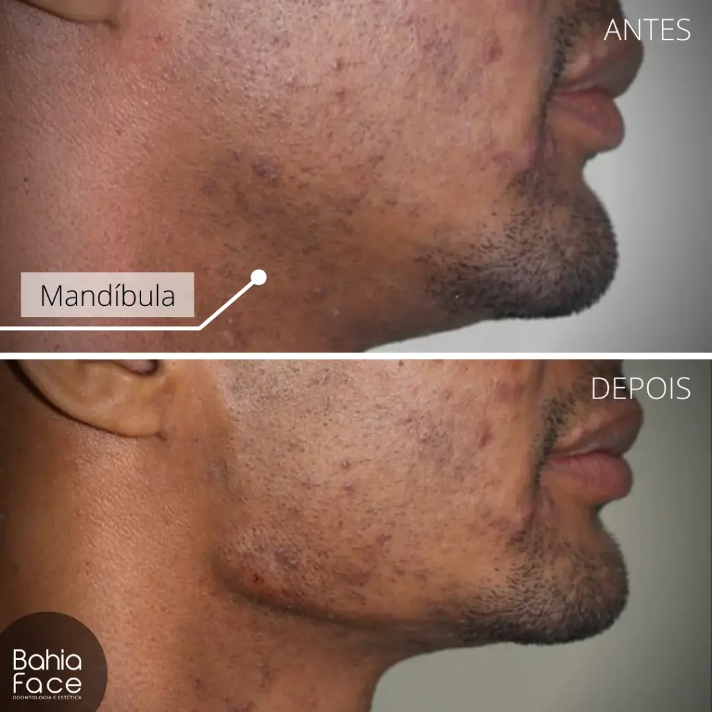 Preenchimento-Antes-e-Depois-1-1