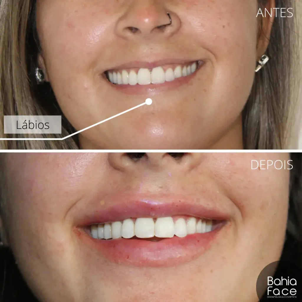 Preenchimento-Antes-e-Depois-4