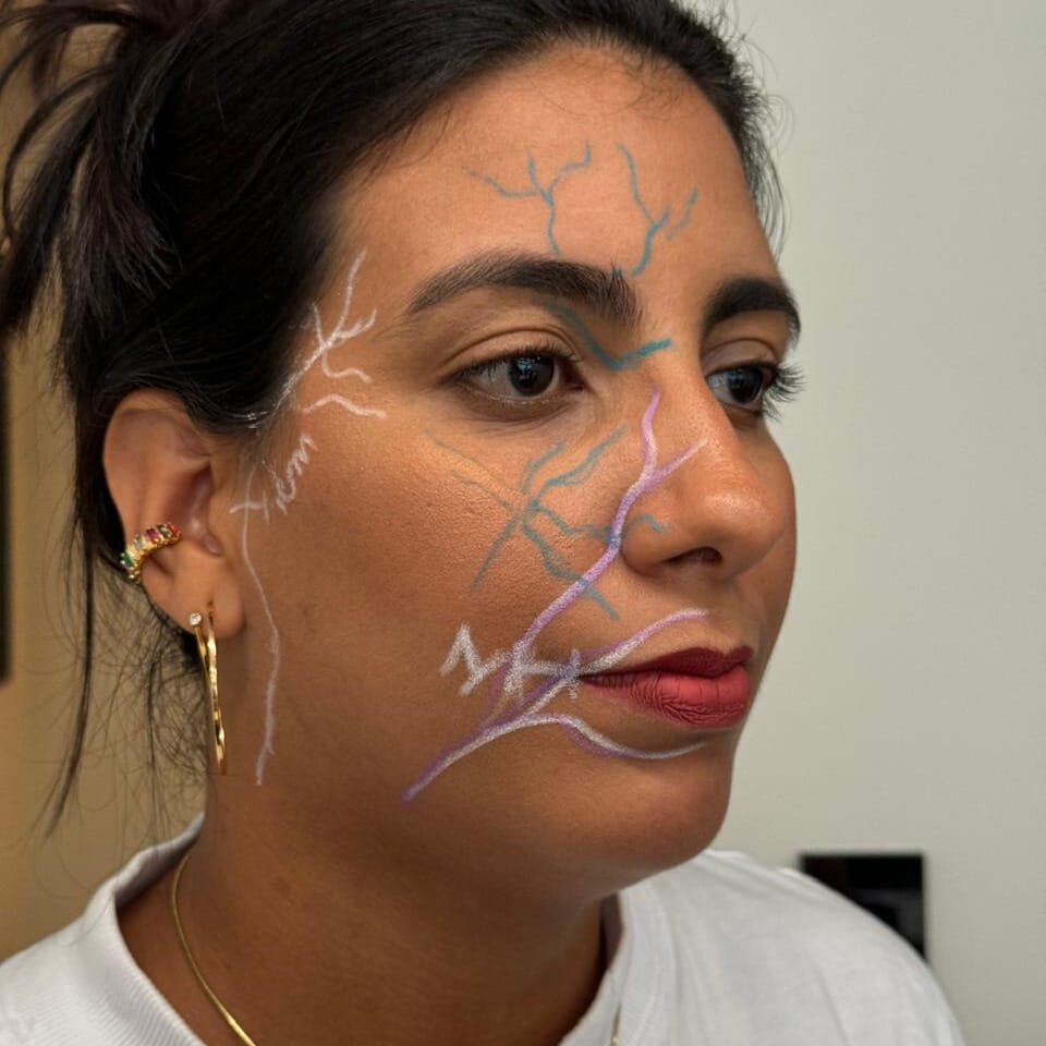 foto de mulher com o rosto marcado para procedimento estetico na aula do instituto bahia face