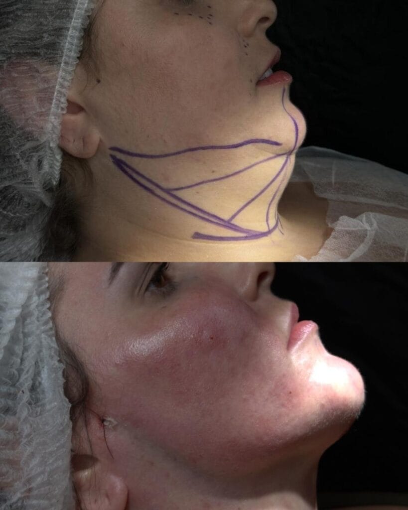 lipo de papada 02