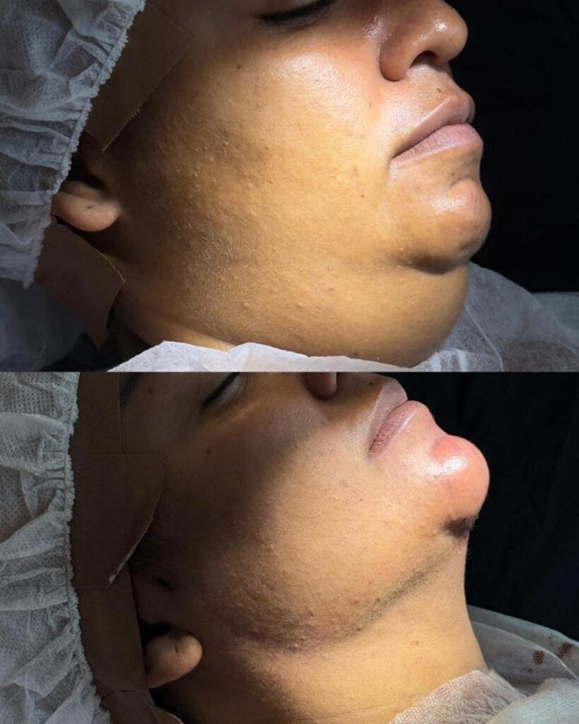 lipo de papada 05